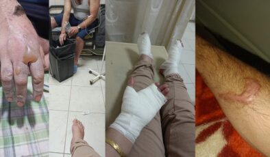 Kimyasal Patlama, İki Kardeşi Yaraladı!